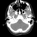 Normal CT of the neck (Radiopaedia 14575-14500 Axial C+ 14).jpg