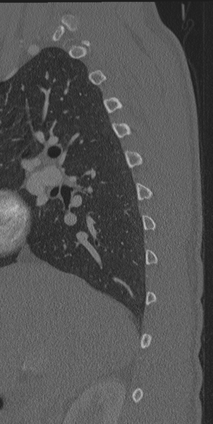 File:Normal CT thoracic spine (Radiopaedia 40181-42688 Sagittal bone window 59).png