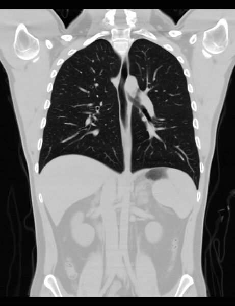 File:Normal CT virtual gastroscopy (Radiopaedia 29960-30501 F 2).jpg