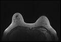 Normal breast MRI - dense breasts (Radiopaedia 80454-93850 Axial T1 47).jpg