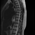 Normal cervical and thoracic spine MRI (Radiopaedia 35630-37156 G 6).png