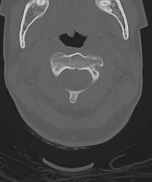 File:Normal cervical spine MRI (including Dixon) (Radiopaedia 42762-45926 Axial bone window 16).png
