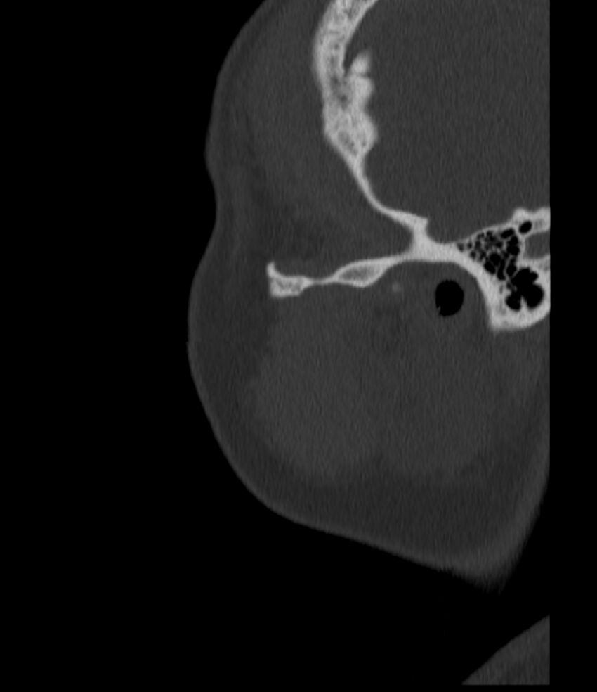 Normal facial bone CT (Radiopaedia 88742-105476 Sagittal bone window 24).jpg
