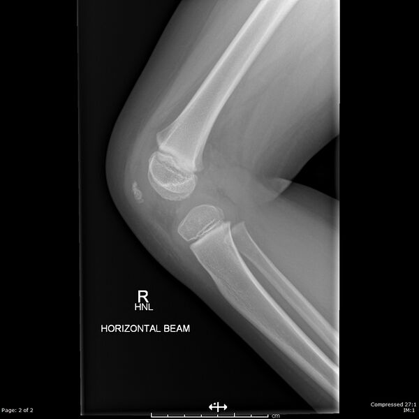 File:Normal knee x-ray - 4-year-old (Radiopaedia 58095-65143 A 1).jpg