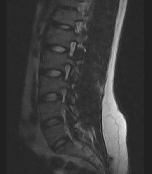 File:Normal lumbar spine MRI - low-field MRI scanner (Radiopaedia 40976-43699 Sagittal T2 4).jpg