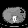 Normal multiphase CT liver (Radiopaedia 38026-39996 Axial non-contrast 22).jpg