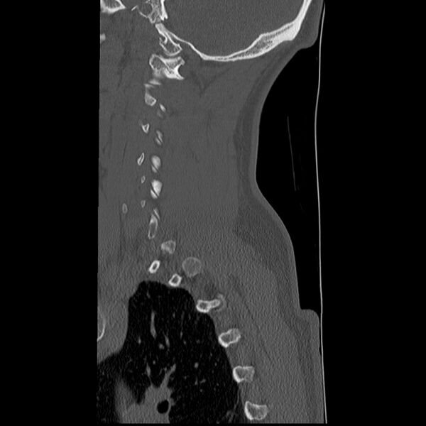 File:Normal trauma spine imaging (Radiopaedia 31753-32686 Sagittal bone window 6).jpg