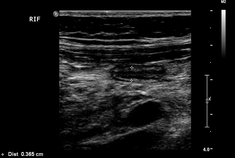 File:Normal vermiform appendix (Radiopaedia 9553-40788 A 5).jpg