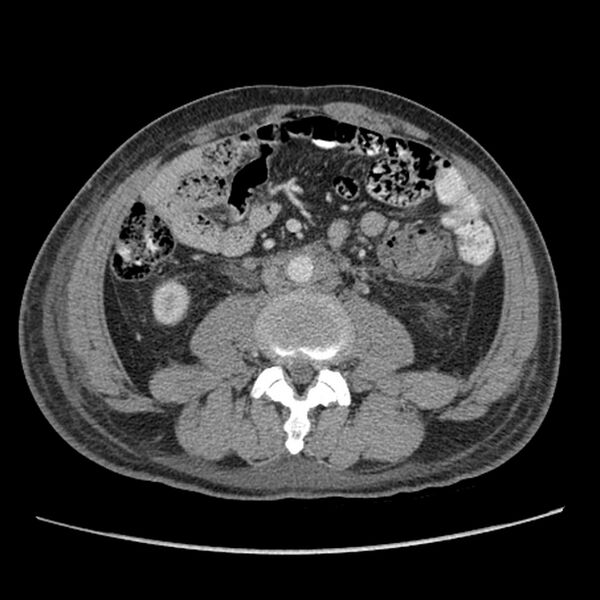 File:Obstructive bladder transitional cell carcinoma (Radiopaedia 9825-10410 A 14).jpg