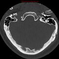 Occipital condyle fracture (Radiopaedia 18366-18208 Axial bone window 3).jpg