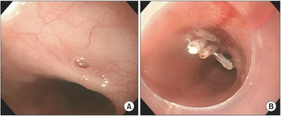 a) 3 mm-sized tracheoesophageal fistula located in esophagus about 33 cm from upper incisor b) endoscopic clipping was done by use of 4 clips