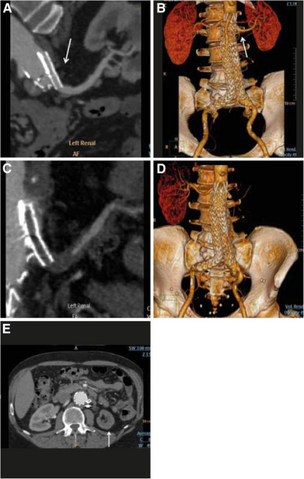 Images a,b,c,d,e) (Malignant) renovascular hypertension caused by a renal artery CG (Chimney graft) occlusion