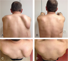 a,c)Medial scapular winging on the right side preoperatively b,d)post-operatively