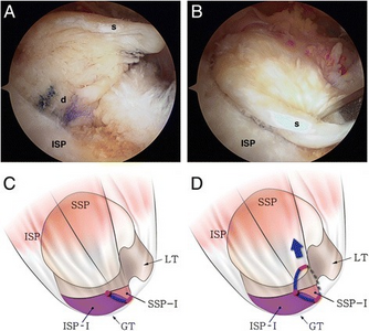 a Intraoperative arthroscopy shows the anteromedial retraction of the superficial layer (s) in a delaminated rotator cuff tear (the same case as in Fig. 1). b The retracted superficial layer was reduced posterolaterally with a tissue grasper. c The illustration shows that the anterosuperior rotator cuff is detached from the greater tuberosity (red line) and the tear progressed into the cuff substance, leading to longitudinal splitting through the supraspinatus or infraspinatus (blue line). d A larger proportion of the supraspinatus (SSP > ISP) in the superficial layer causes anteromedial retraction (type S2) (dotted line elongated rotator interval tissue, red circle end of cuff tear, SSP supraspinatus, ISP infraspinatus, GT greater tuberosity, LT lesser tuberosity, ISP-I footprint of the infraspinatus , SSP-I footprint of the supraspinatus )