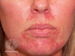 Perioral dermatitis (DermNet NZ acne-perioral-dermatitis-3413).jpg