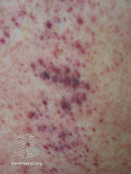 File:Petechiae due to thrombocytopenia (DermNet NZ bleeding-disorder-09).jpg
