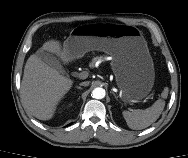 File:Abdominal aortic aneurysm (Radiopaedia 22421-22458 C+ arterial phase 12).jpg