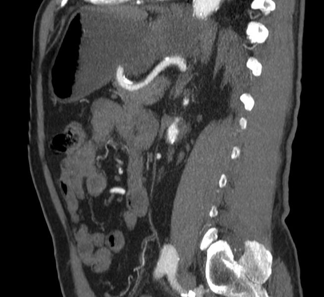 File:Abdominal aortic aneurysm (Radiopaedia 22421-22458 D 28).jpg
