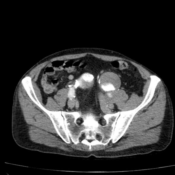 File:Abdominal aortic aneurysm (Radiopaedia 29248-29660 Axial C+ arterial phase 67).jpg