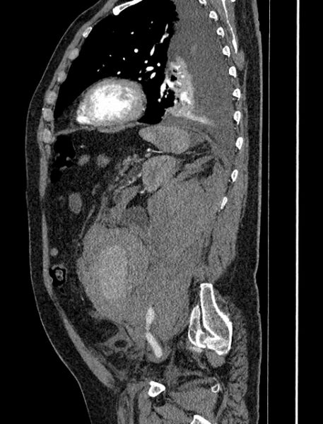 File:Abdominal aortic aneurysm rupture (Radiopaedia 54179-60362 Sagittal C+ arterial phase 30).jpg