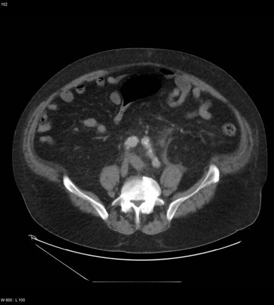File:Abdominal aortic aneurysm with intramural hematoma then rupture (Radiopaedia 50278-55631 Axial C+ arterial phase 93).jpg