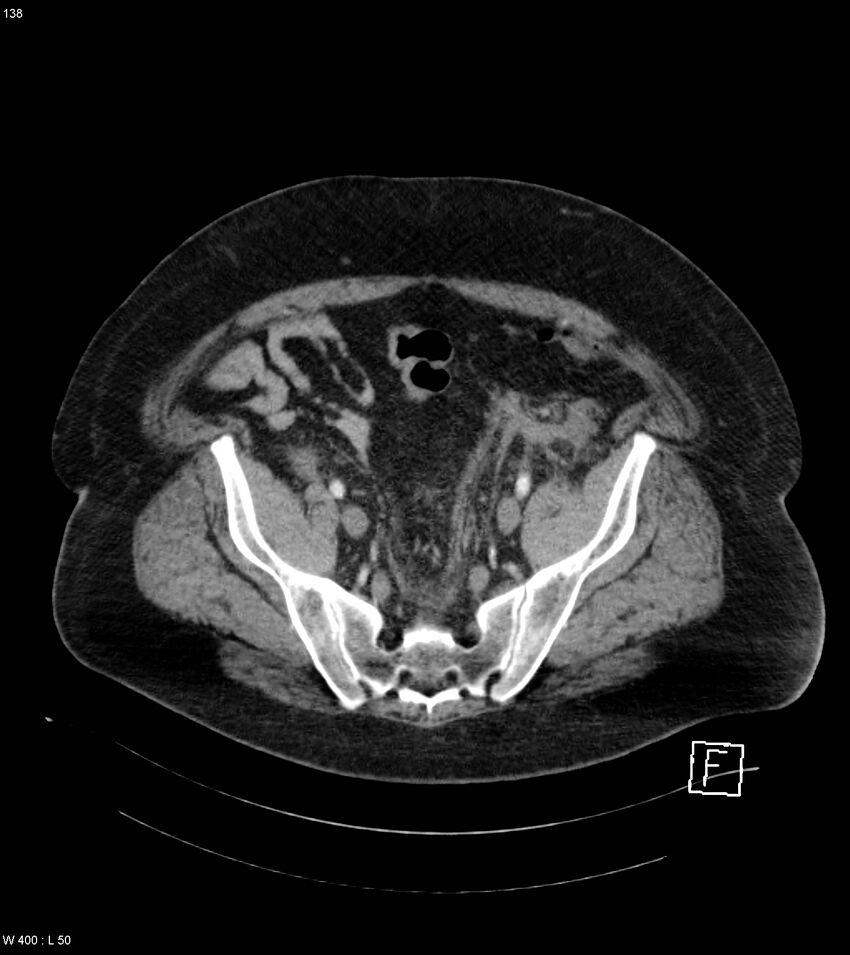 Abdominal aortic aneurysm with intramural hematoma then rupture (Radiopaedia 50278-55632 Axial C+ arterial phase 137).jpg