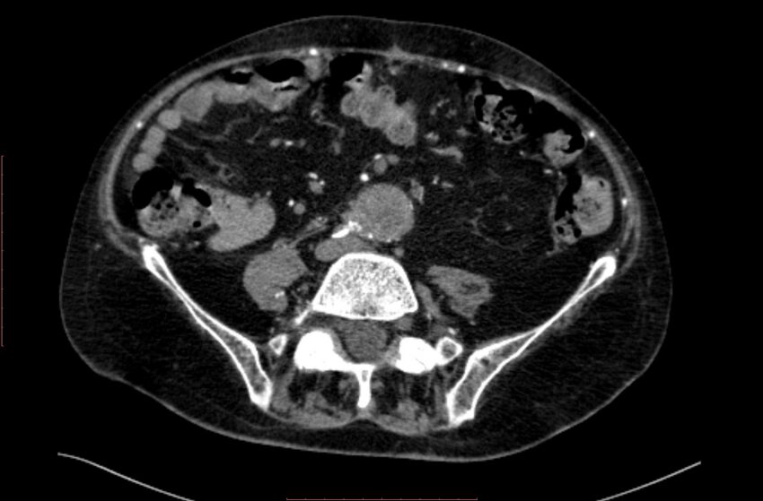 Abdominal aortic interposition tube graft and aneurysm thrombosis (Radiopaedia 71438-81857 Axial C+ arterial phase 128).jpg