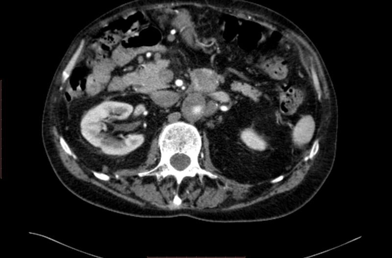 File:Abdominal aortic interposition tube graft and aneurysm thrombosis (Radiopaedia 71438-81857 Axial C+ arterial phase 44).jpg