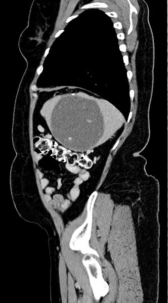 File:Abdominal hydatid disease (Radiopaedia 68223-77737 Sagittal C+ portal venous phase 12).jpg
