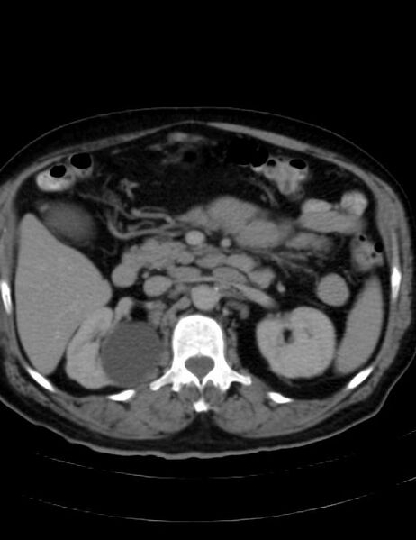 File:Abdominal lymphoma - with sandwich sign (Radiopaedia 53486-59492 Axial C+ portal venous phase 19).jpg
