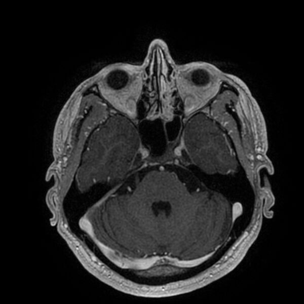 File:Acoustic schwannoma - intracanalicular (Radiopaedia 37247-39024 Axial T1 C+ 76).jpg