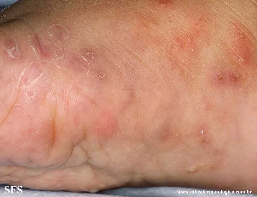 Acropustulosis Infantile (Dermatology Atlas 15).jpg