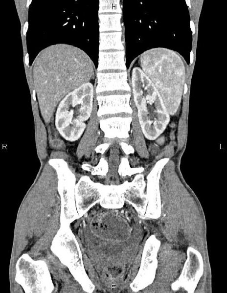 File:Active crohn disease (Radiopaedia 87133-103397 Coronal C+ arterial phase 46).jpg