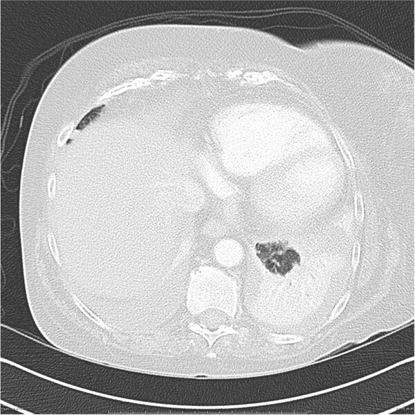 File:Acute-on-chronic pulmonary emboli (Radiopaedia 27925-28169 lung window 39).jpg