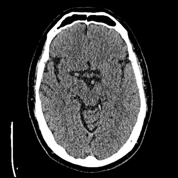 File:Acute A3 occlusion with ACA ischemic penumbra (CT perfusion) (Radiopaedia 72036-82525 Axial non-contrast thins 14).jpg