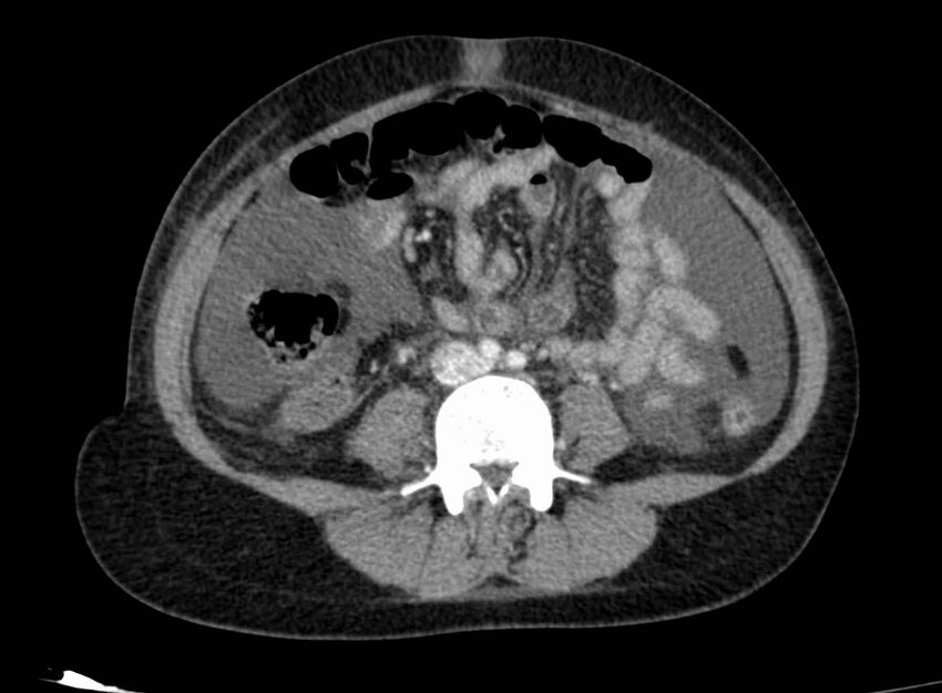 Acute Budd-Chiari syndrome (Radiopaedia 60858-68638 Axial C+ portal venous phase 183).jpg