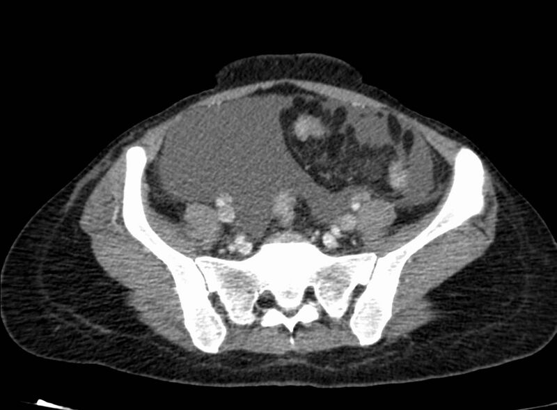 File:Acute Budd-Chiari syndrome (Radiopaedia 60858-68638 Axial C+ portal venous phase 228).jpg