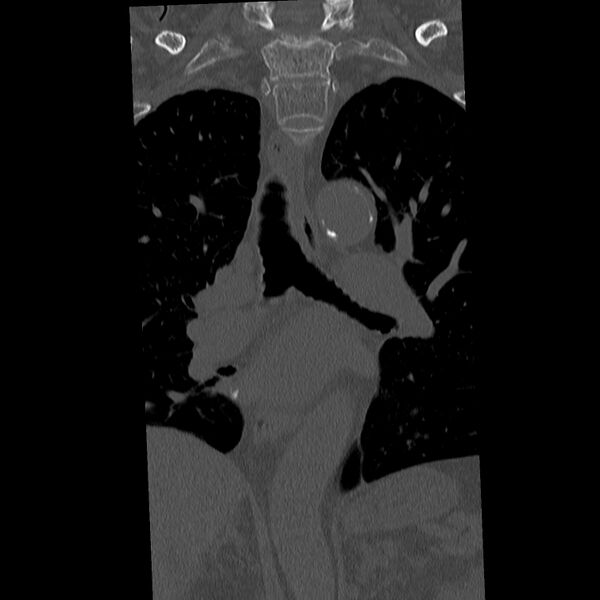 File:Acute and chronic vertebral compression fractures (Radiopaedia 31608-32494 Coronal bone window 6).jpg