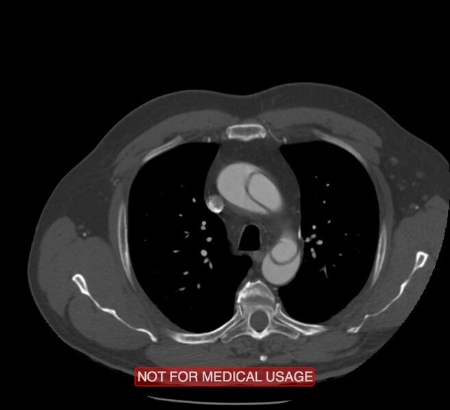 File:Acute aortic dissection - Stanford type A (Radiopaedia 40661-43285 Axial C+ arterial phase 11).jpg