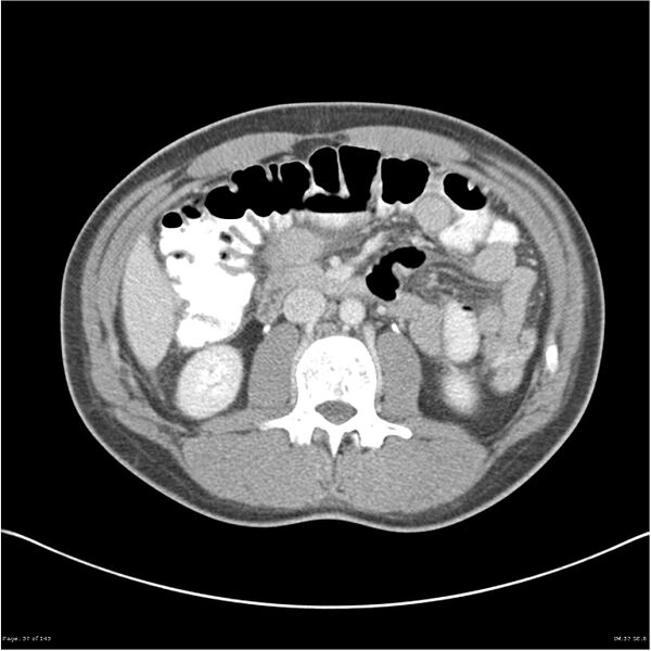 File:Acute appendicitis (Radiopaedia 25364-25615 B 27).jpg