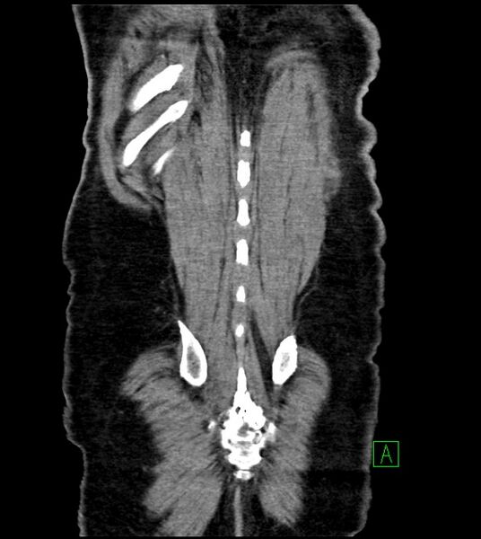 File:Acute arterial mesenteric ischemia (Radiopaedia 78238-90828 Coronal C+ portal venous phase 82).jpg