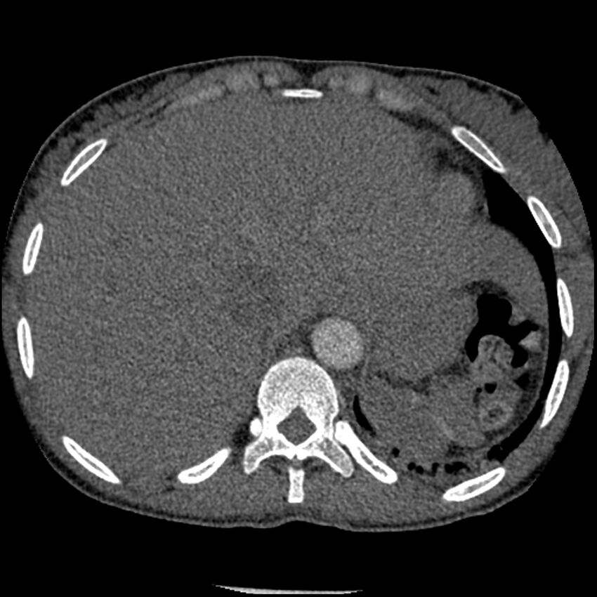 Acute chest syndrome - sickle cell disease (Radiopaedia 42375-45499 Axial C+ CTPA 169).jpg