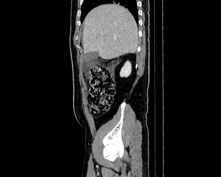 File:Acute cholecystitis (Radiopaedia 53216-59182 Sagittal C+ portal venous phase 4).jpg