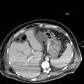 Acute pancreatic necrosis (Radiopaedia 13560-18501 Axial C+ portal venous phase 27).jpg
