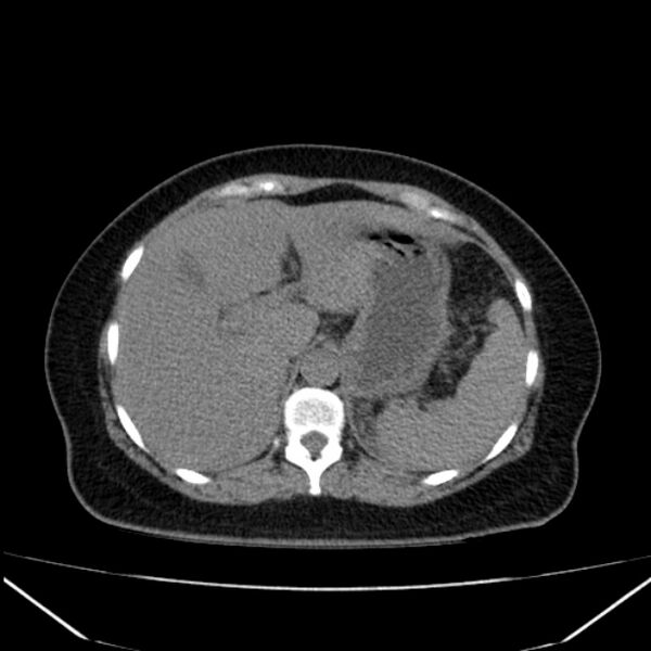 File:Acute pancreatitis - Balthazar C (Radiopaedia 26569-26714 Axial non-contrast 24).jpg