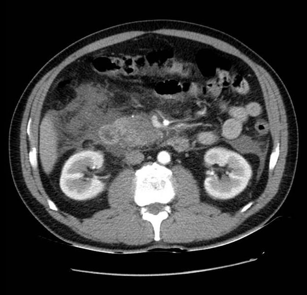 File:Acute pancreatitis - Balthazar E (Radiopaedia 23080-23110 Axial C+ arterial phase 31).jpg