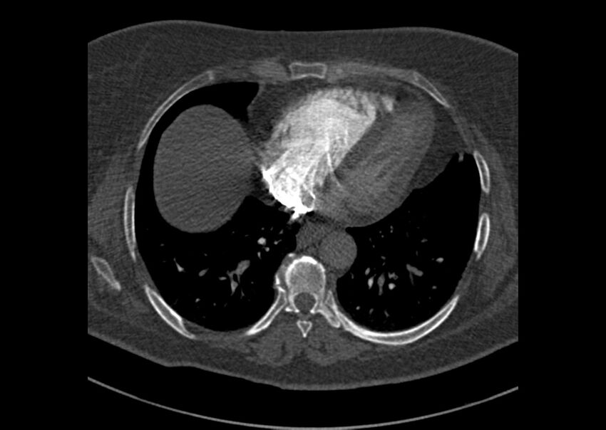 Acute pulmonary embolism (Radiopaedia 29938-30466 Axial C+ CTPA 155).jpg