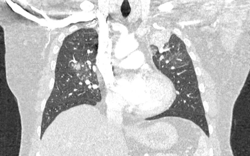 File:Acute pulmonary embolism with pulmonary infarcts (Radiopaedia 77688-89908 Coronal lung window 38).jpg