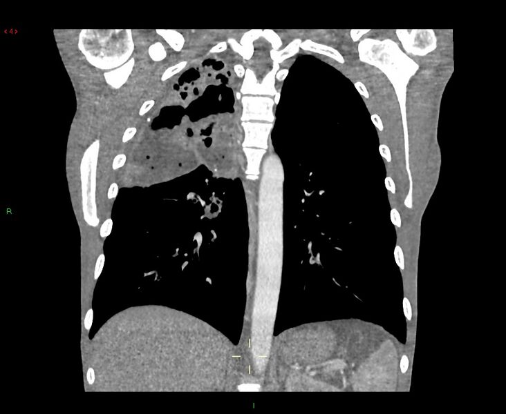 File:Acute right lung abscess (Radiopaedia 34806-36258 Coronal C+ arterial phase 18).jpg