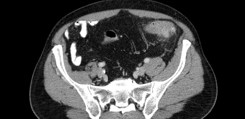 Acute sigmoid colon diverticulitis (Radiopaedia 55507-61976 Axial C+ portal venous phase 74).jpg